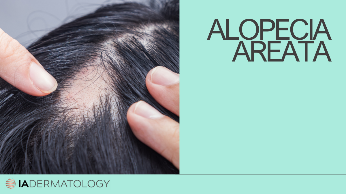 Alopecia areata