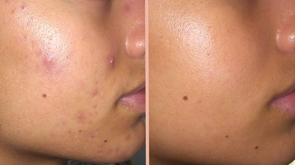 Acne before after IA dermatology