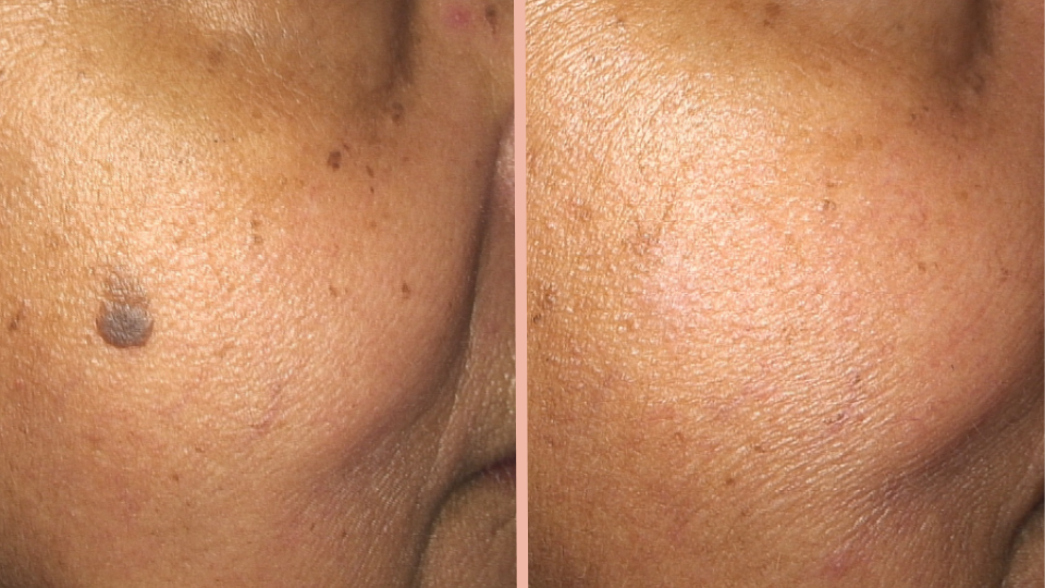 Mole Screening Removal before after IA dermatology