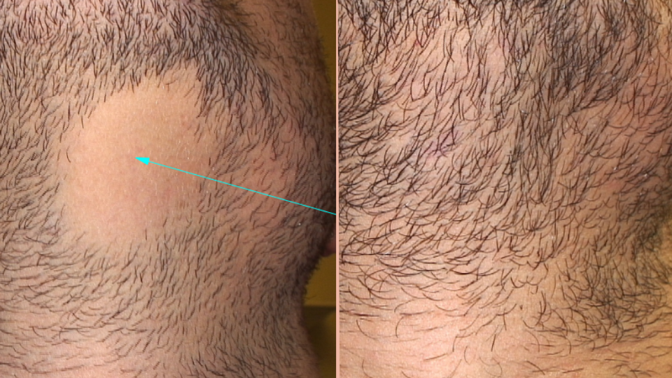 Alopecia before after IA dermatology