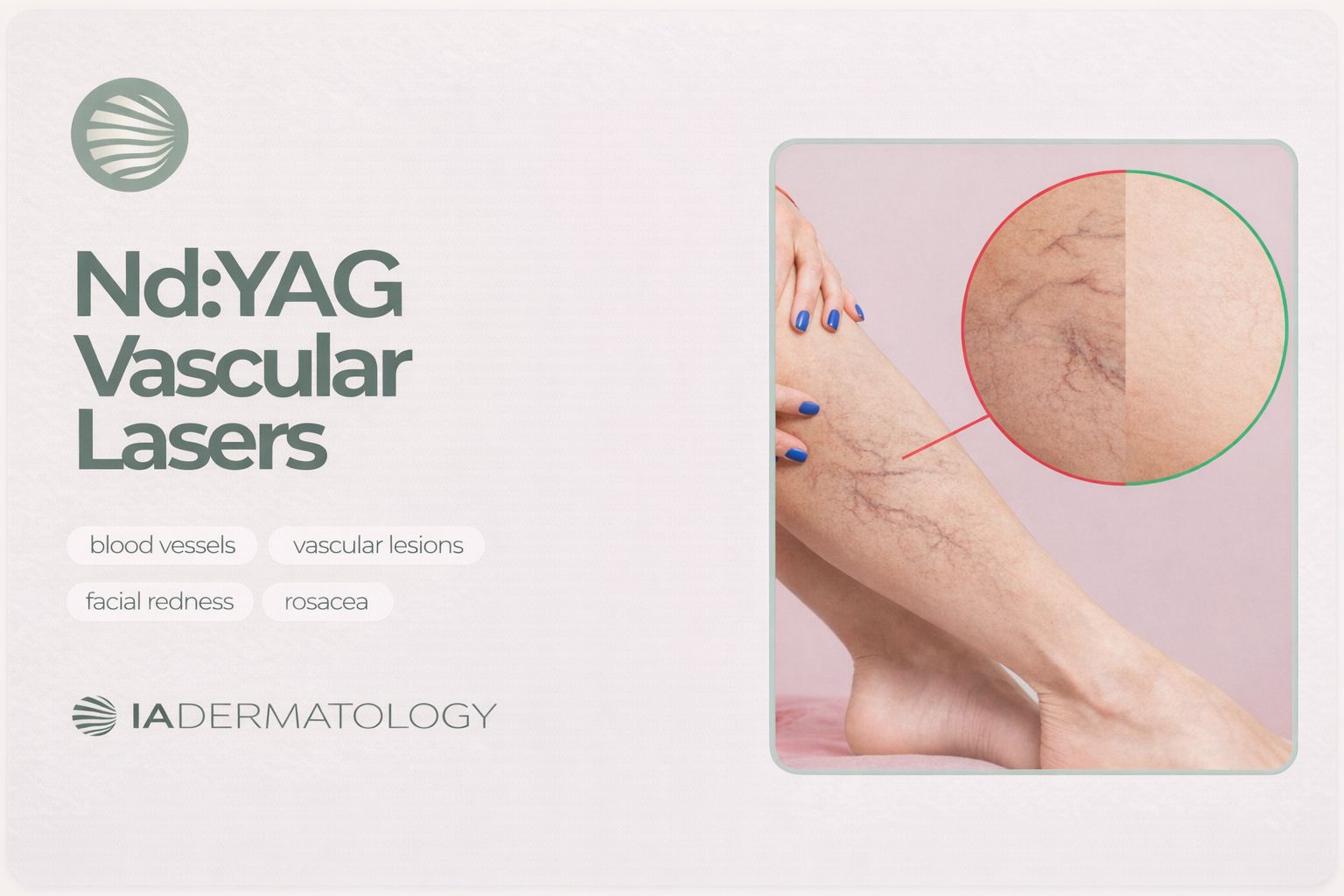 Nd:YAG Laser at IADermatology, Harley Street, London