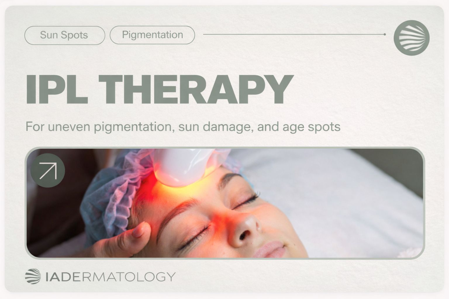 IPL Therapy for Sun Spots and Pigmentation