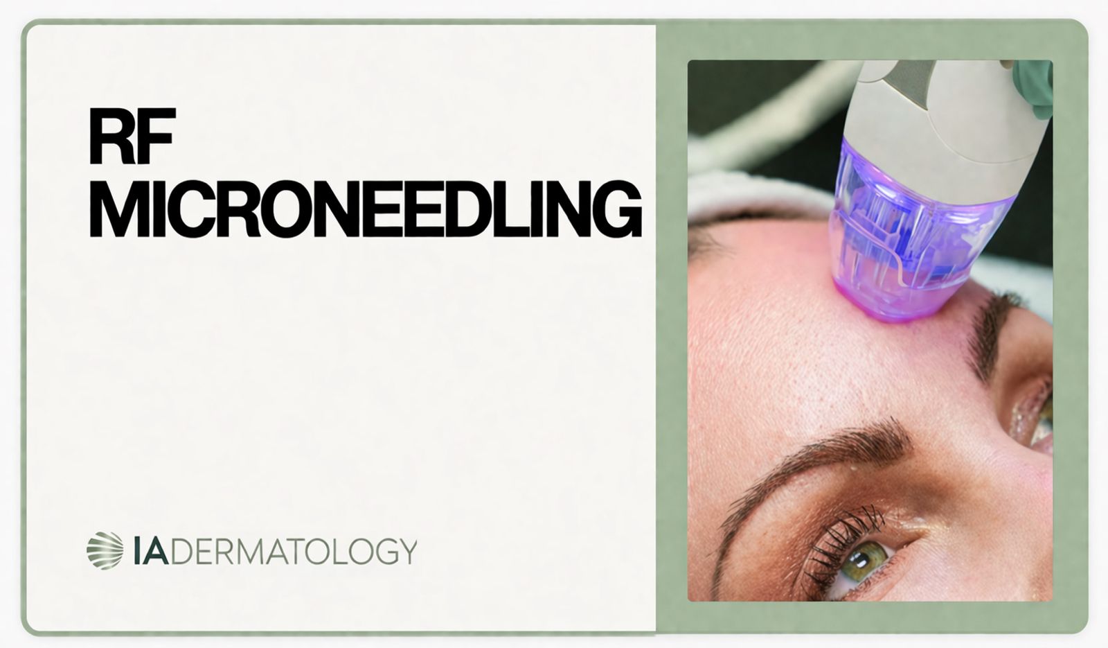 rf microneedling