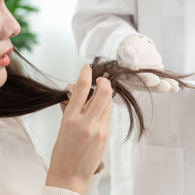PCOS-related hair thinning