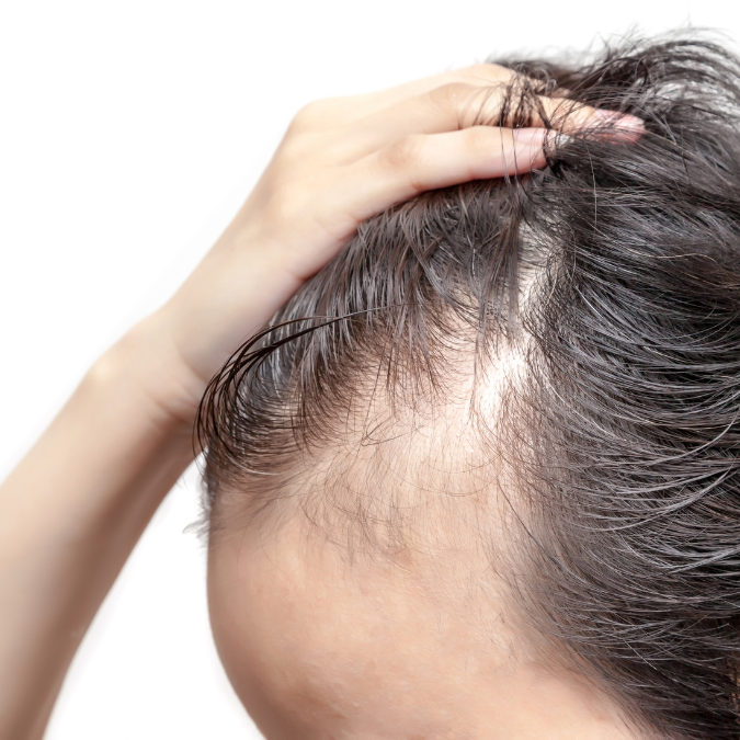 Frontal Fibrosing Alopecia →