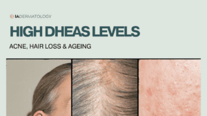 High DHEAS Levels