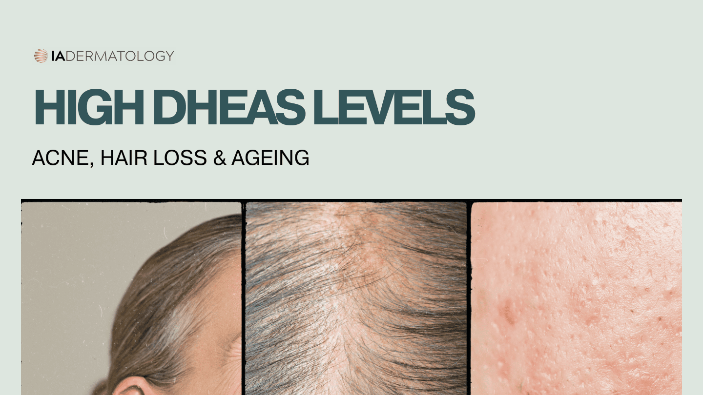High DHEAS Levels